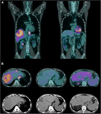 Case Report: The molecular fingerprint and the clinical implication of an exceptional response to neoadjuvant therapy in a metastatic cardia adenocarcinoma